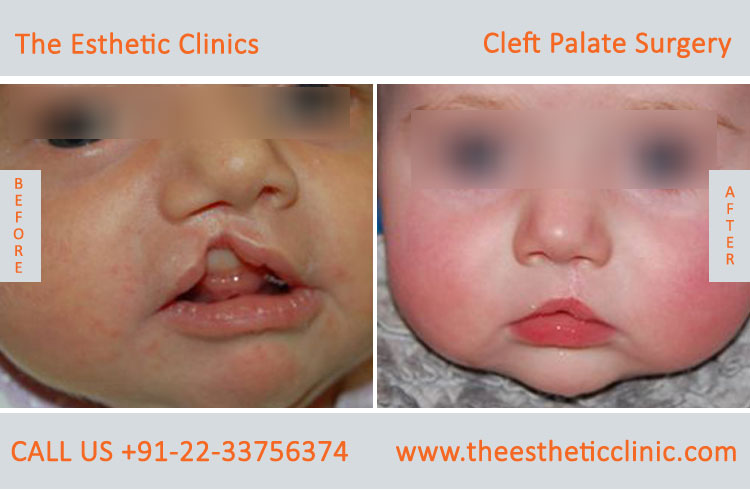 cleft palate surgery, Cleft Palate Repair Treatment before after photos in mumbai india (4)
